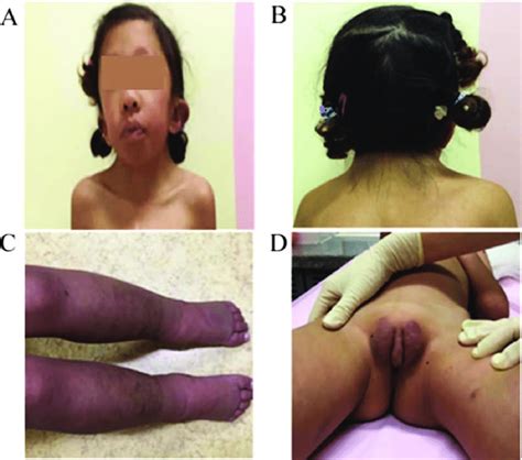 Characteristic Facial Features Of The Patient With Noonan Syndrome A