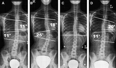 Scoliosis Radiology Key