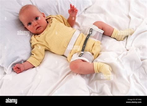 Young Baby With Hip Dysplasia Splint Ddh Developmental Dysplasia