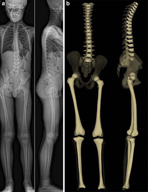 Idiopathic Scoliosis In Children And Adolescents Assessment With A