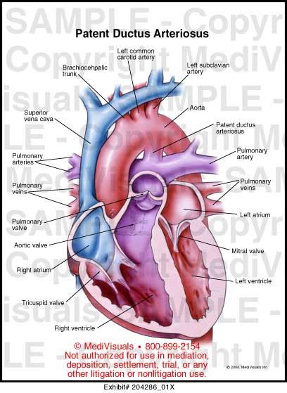 Medivisuals Patent Ductus Arteriosus Medical Illustration