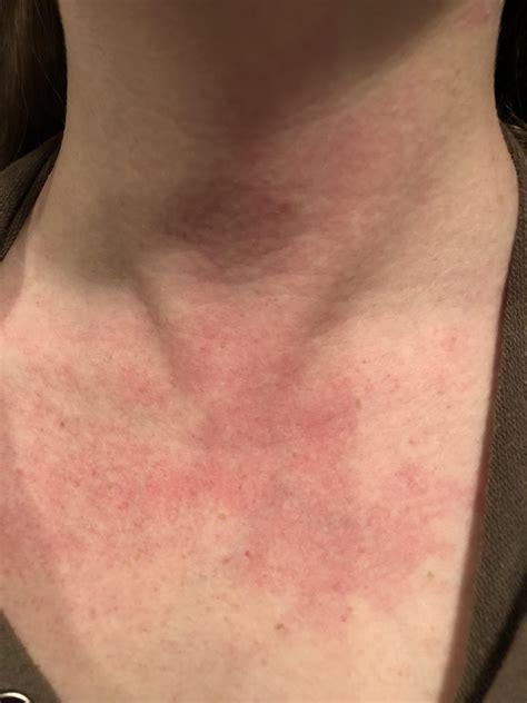 Lupus Rash On Neck And Chest