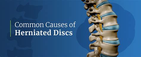 What Causes A Herniated Disc Spine INA New Jersey