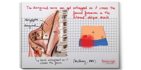 Mcsherry Ilio Inguinal Nerve Backmice Info