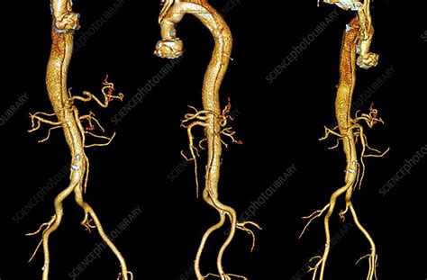 Dissecting Aorta 3d Angio Ct Scans Stock Image C0215950 Science