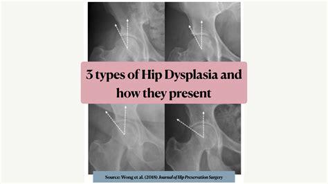 3 Types Of Hip Dysplasia And How They Present Runningphysio