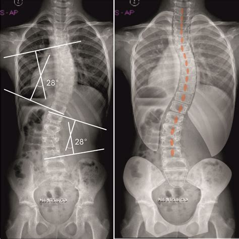 Medium Rotated Scoliosis Ati And The Cobb Angle Correlate With Each