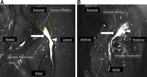 Gluteus Medius Tendinopathy Mri