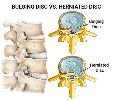 What Happens If A Bulging Disc Goes Untreated The Spine Rehab Group