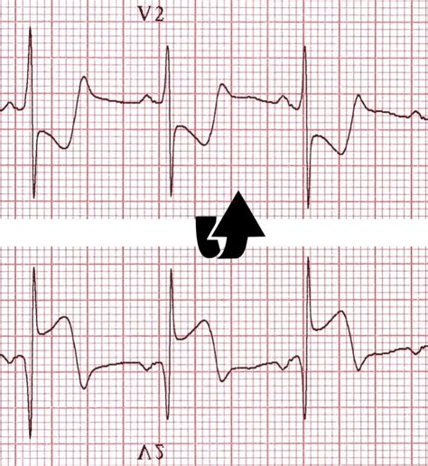 Lateral Stemi Ecg Changes Litfl Ecg Library Diagnosis