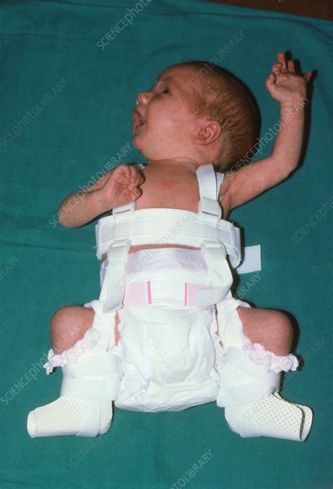 A Newborn Baby Affected By Dislocation Of The Hip Stock Image M350