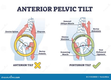 Anterior Pelvic Tilt Model Compared With Posterior In Labeled Outline