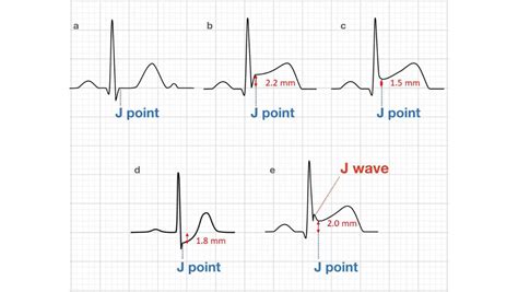 Stemi St Elevation Myocardial Infarction Diagnosis