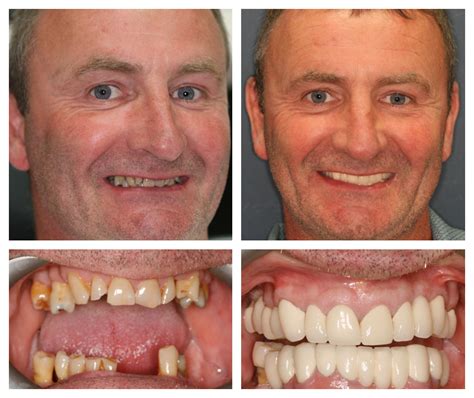 Dental Crowns Cosmetic Dentists Oakley Dental Manchester