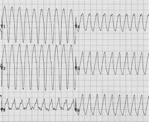 Ventricular Tachycardia Monomorphic Vt • Litfl • Ecg Library