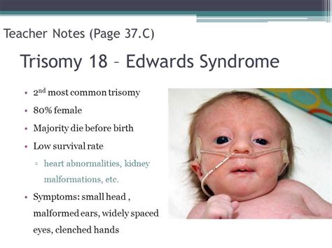 Pin De Nonas Arc En Trisomy 18 Aka Edwards Syndrome Edwards Syndrome