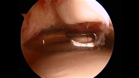 Complications may include an associated high ankle sprain, compartment syndrome, decreased range of motion, and malunion. Ankle Scope Medial Malleolus Fracture SFISM - YouTube