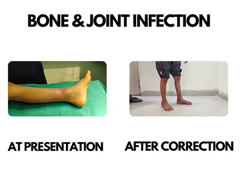 Bones And Joint Infection Dr Deepak Khurana Paediatric Orthopaedic