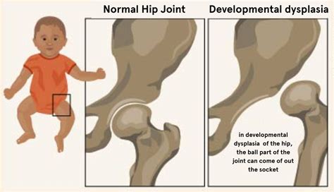 Mengenal Kelainan Bentuk Pinggul Hip Dysplasia