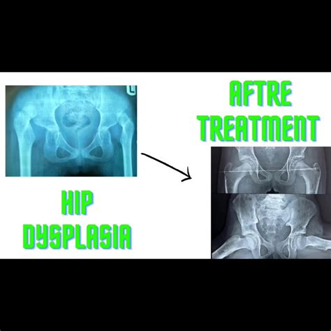 Hip Dysplasia Is A Treatable Cause Of Early Arthritis Of The Hip Joint