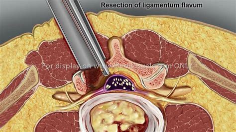 Lumbar Spine Decompression Surgery D33696 On Vimeo