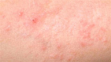 Heat Rash Pictures Remedies And More