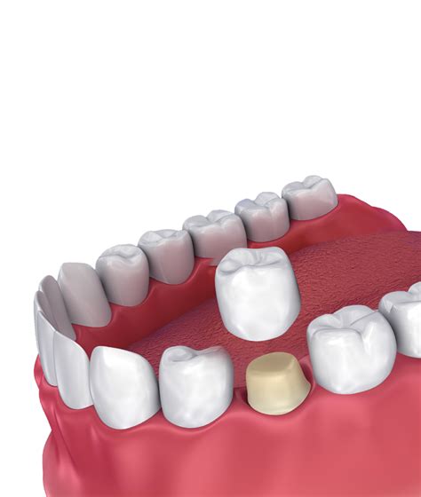 The Complete Guide To Dental Crowns What You Need To Know Latakentucky