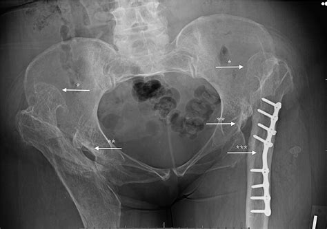 Abnormal Anatomical And Radiological Changes In A Rare Presentation Of