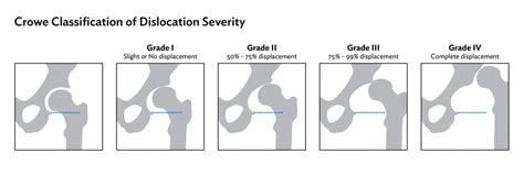 Diagnosis International Hip Dysplasia Institute