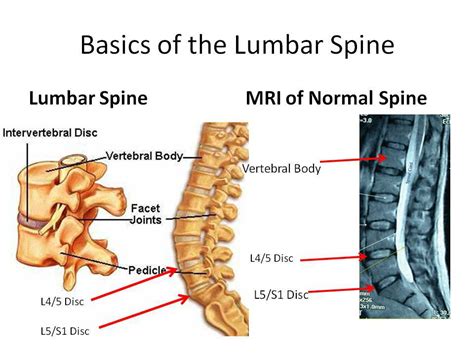 How To Read An Mri Of The Lumbar Spine