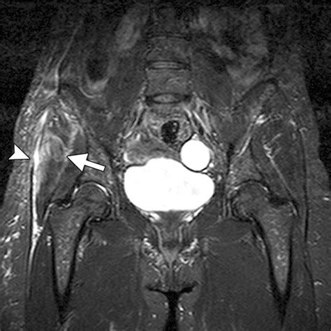 Injury Of The Gluteal Aponeurotic Fascia And Proximal Iliotibial Band