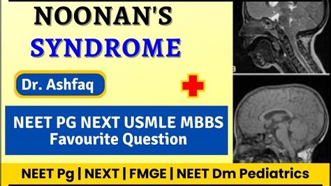 Noonans Syndrome NEET PG NEXT USMLE MBBS Favourite Question YouTube