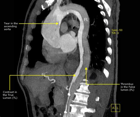 Aortic Dissection Rcemlearning