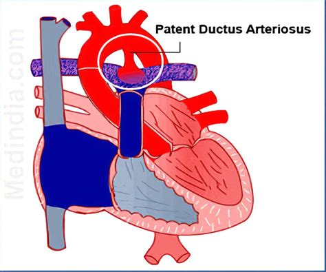 Conus Arteriosus