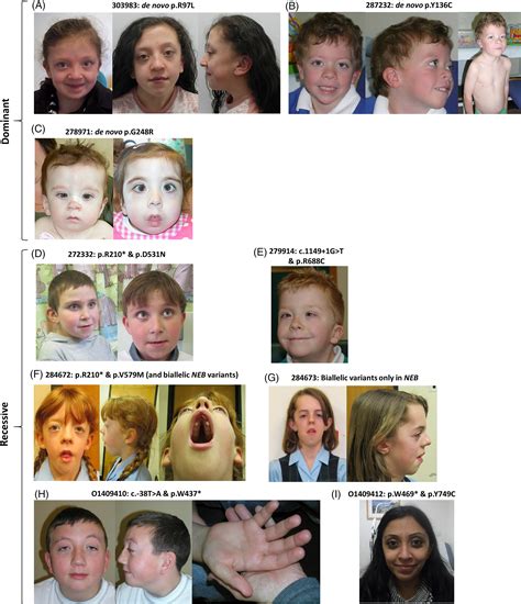 Delineation Of Dominant And Recessive Forms Of LZTR1associated Noonan