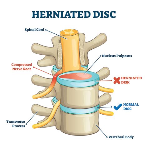 Herniated Disc Treatment No Drugs Or Surgery Scottsdale