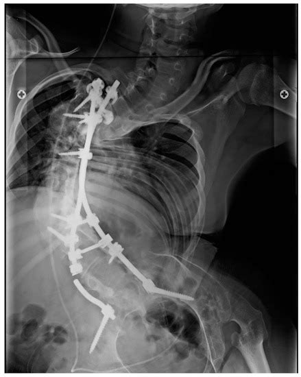 Applied Sciences Free Full Text Correlation Between Scoliosis