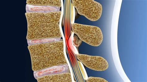 Minimally Invasive Lumbar Decompression Mild Central States Pain Clinic