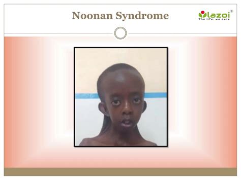 Ppt Noonan Syndrome Causes Symptoms Daignosis Prevention And