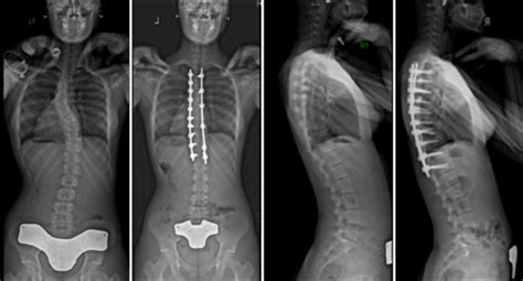 Commonly Performed Scoliosis Surgeries Before And After—2an Michael G