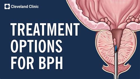 Benign Prostatic Hyperplasia Pathophysiology Diagram