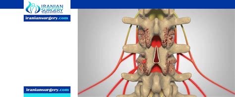 Laminectomy Recovery Time Laminectomy Back Surgery Recovery Time