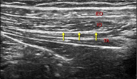 Right Ilioinguinal Nerve Block