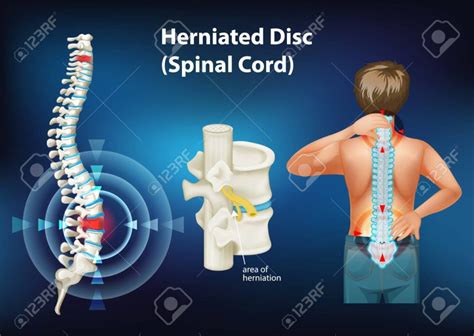 Stem Cell Treatment For Herniated Discs Regenerative Orthopedic Institute