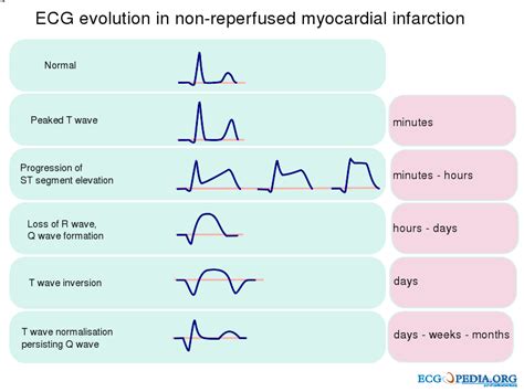 Cómo Reconocer Un Stemi En Un Ekg De 12 Derivaciones Ecctrainings