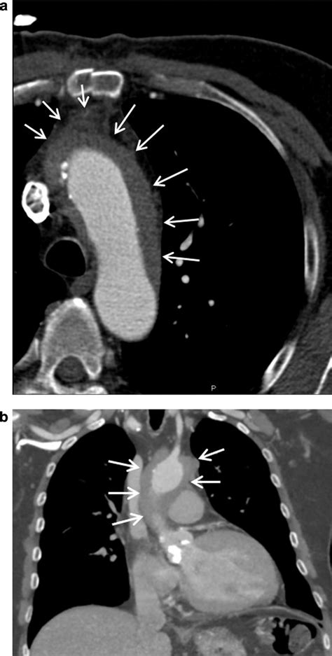 A And B Ct Scan Of Ascending Aorta And Arch White Arrows Mark The