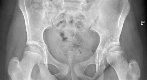 Developmental Dysplasia Of The Hip