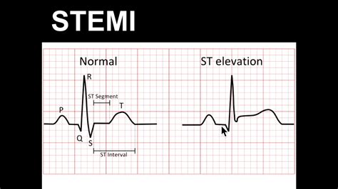 St Elevation On Ekg