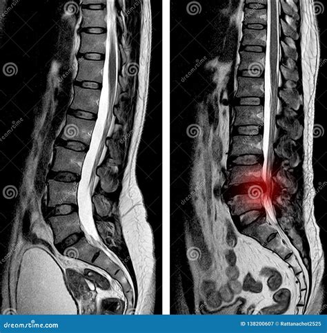 Mri Scan Sagittal View Lumbosacral Spine Has Straightening Lumbar