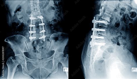 X Ray Image Of Lumbar Spine Postoperative Treatment For Degenerative